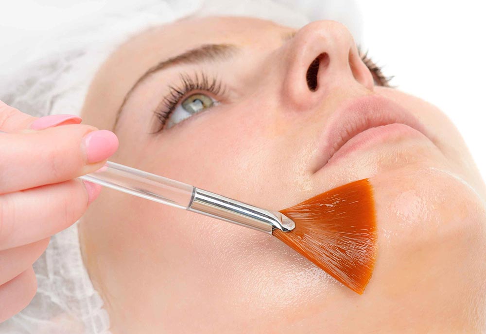 peeling-quimico-facial