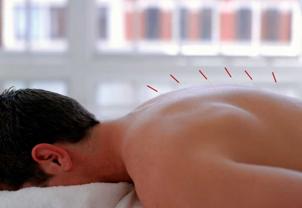 acupuntura-aplicacao